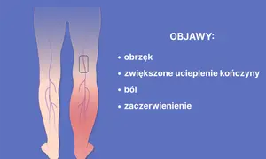 Objawy zakrzepicy nóg: Rozpoznaj je i uratuj życie.