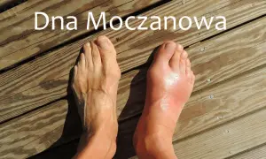 Podagra: Co to za choroba? Objawy, leczenie i skuteczna dieta