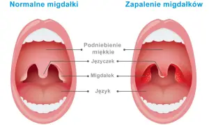 Migdałki NFZ: Jak skrócić kolejkę? Znajdź termin w kilka dni!