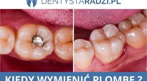 Plomba na NFZ: Co naprawdę oznacza "za darmo" i co Ci przysługuje?