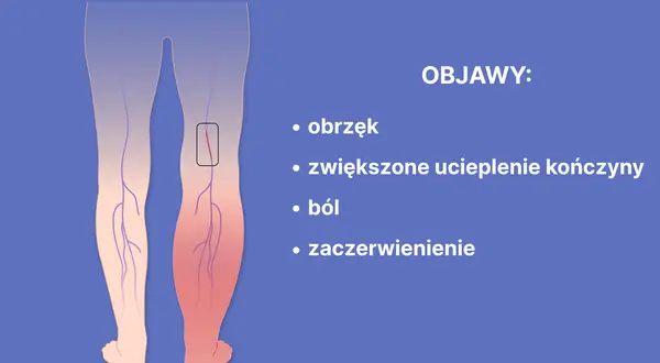 Objawy zakrzepicy nóg: Rozpoznaj je i uratuj życie.