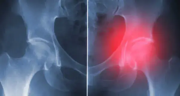 Jakie endoprotezy stawu biodrowego refunduje NFZ i co musisz wiedzieć