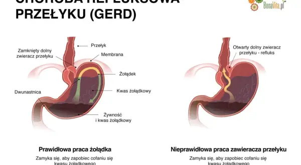Refluks: Objawy, leczenie, dieta. Odzyskaj komfort!