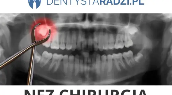 Chirurgia stomatologiczna NFZ: Co pokrywa Fundusz? Pełny przewodnik