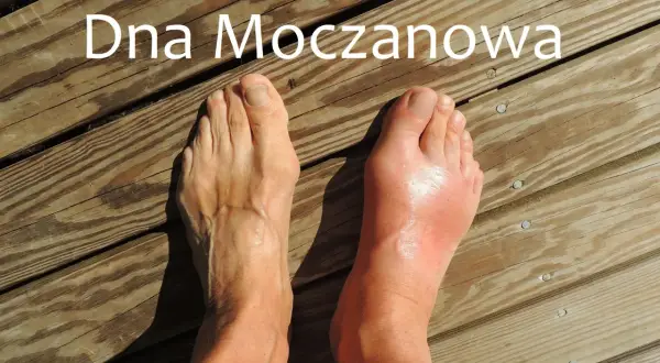 Dna moczanowa: Jak rozpoznać, leczyć i żyć bez bólu?