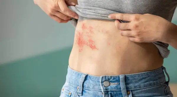 Jakie leki przeciwbólowe na półpasiec pomogą złagodzić ból?