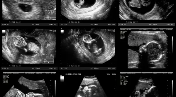 Badania prenatalne 2 trymestr: Twój przewodnik po zdrowiu dziecka