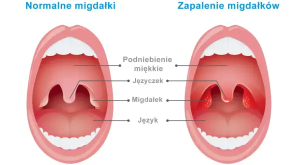 Migdałki NFZ: Jak skrócić kolejkę? Znajdź termin w kilka dni!