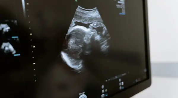 Obraz USG z widocznym profilem dziecka. To ważne badania prenatalne 1 trymestr, które pozwalają ocenić rozwój malucha.