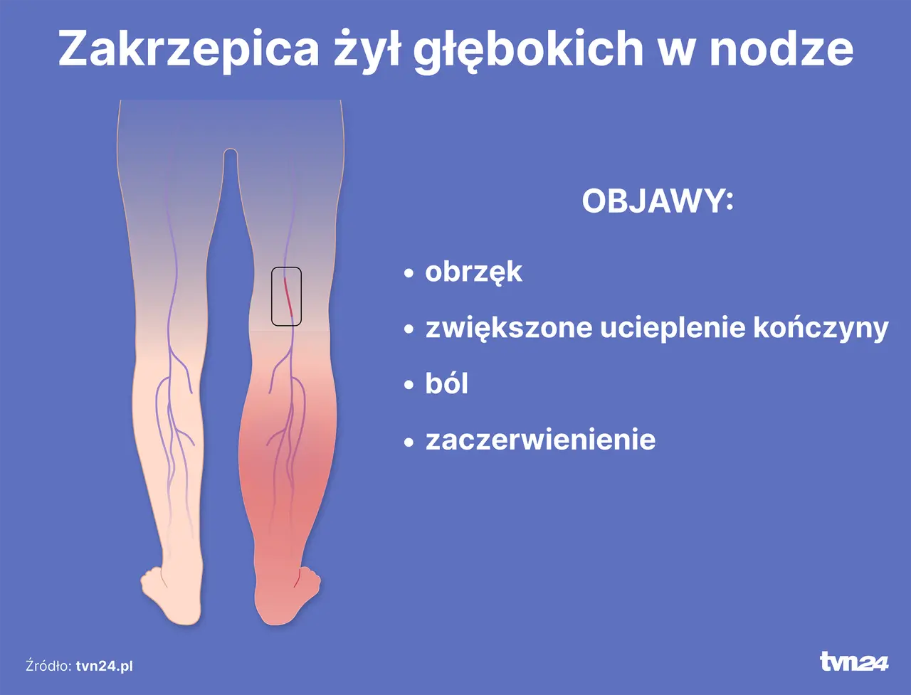 Objawy zakrzepicy nóg: Rozpoznaj je i uratuj życie.