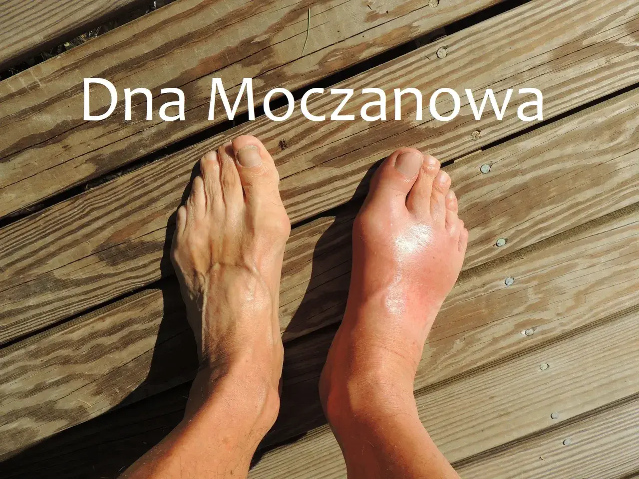 Podagra: Co to za choroba? Objawy, leczenie i skuteczna dieta
