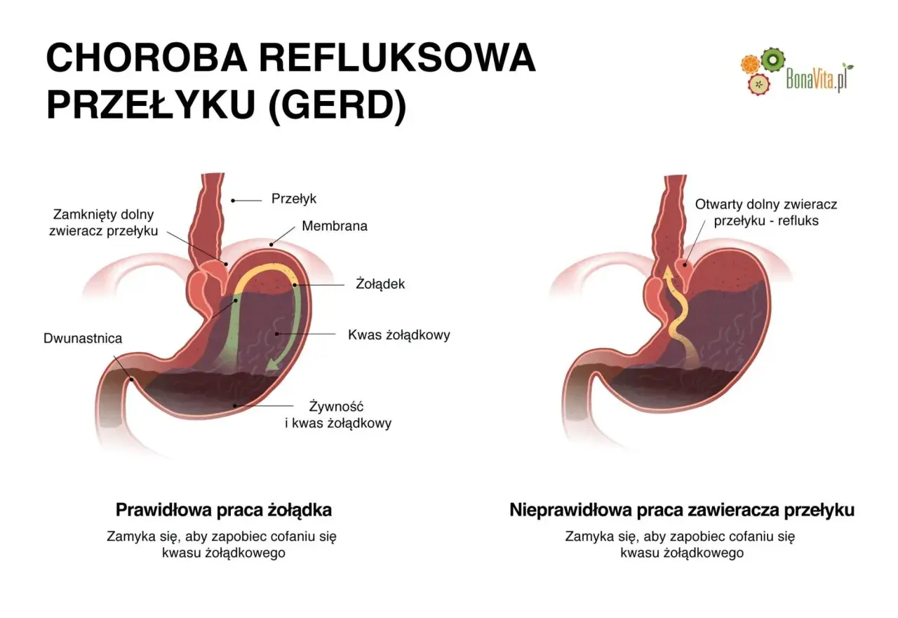 Refluks: Objawy, leczenie, dieta. Odzyskaj komfort!