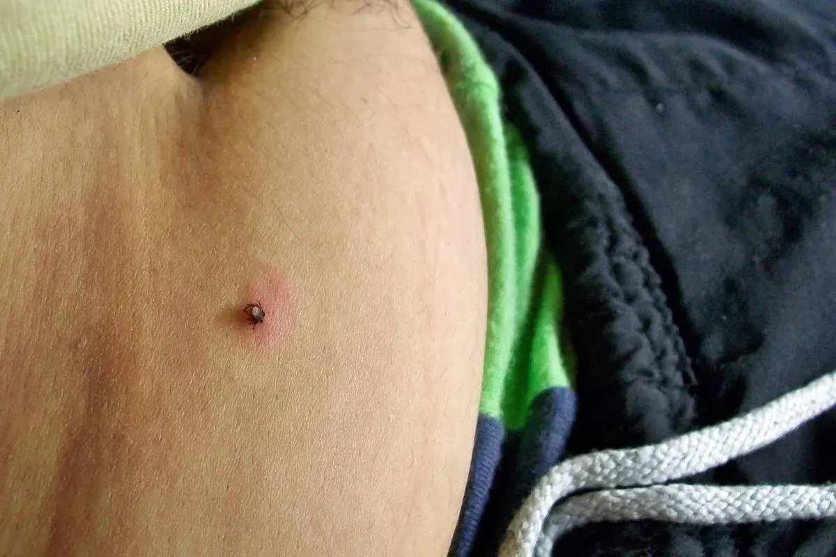 Kleszcz pod skórą: Czy to groźne? Objawy, KZM, rumień poradnik