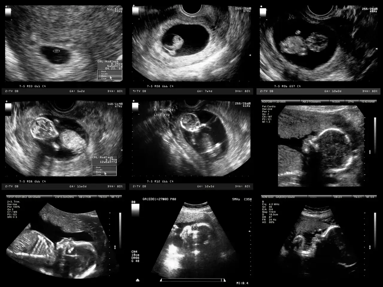 Badania prenatalne 2 trymestr: Twój przewodnik po zdrowiu dziecka