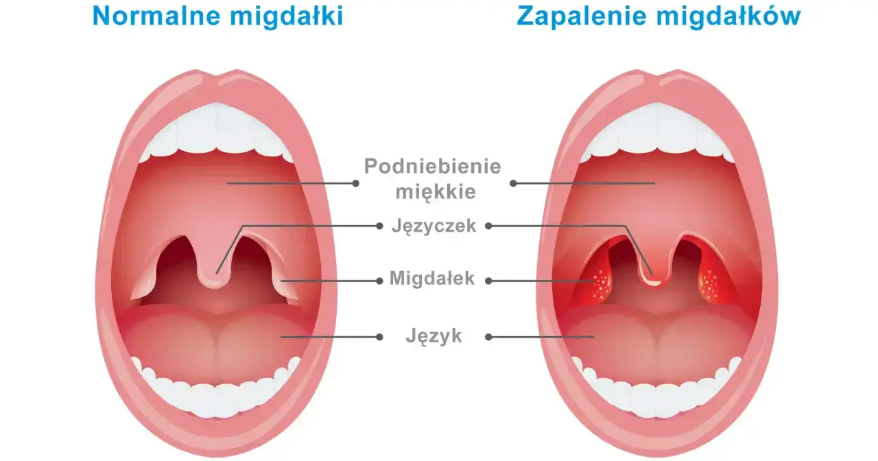 Migdałki NFZ: Jak skrócić kolejkę? Znajdź termin w kilka dni!