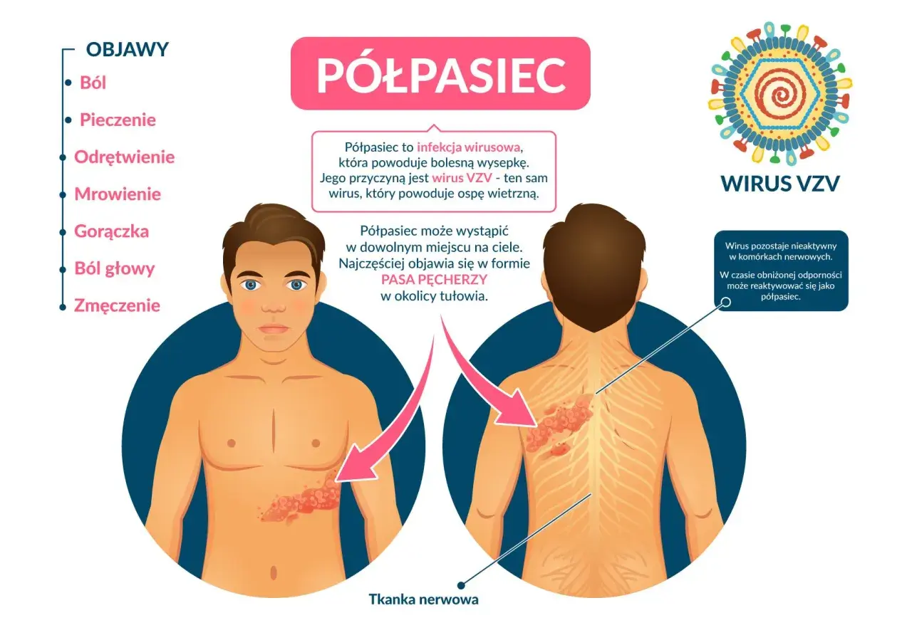 Półpasiec po COVID-19: Czy koronawirus budzi uśpiony wirus?