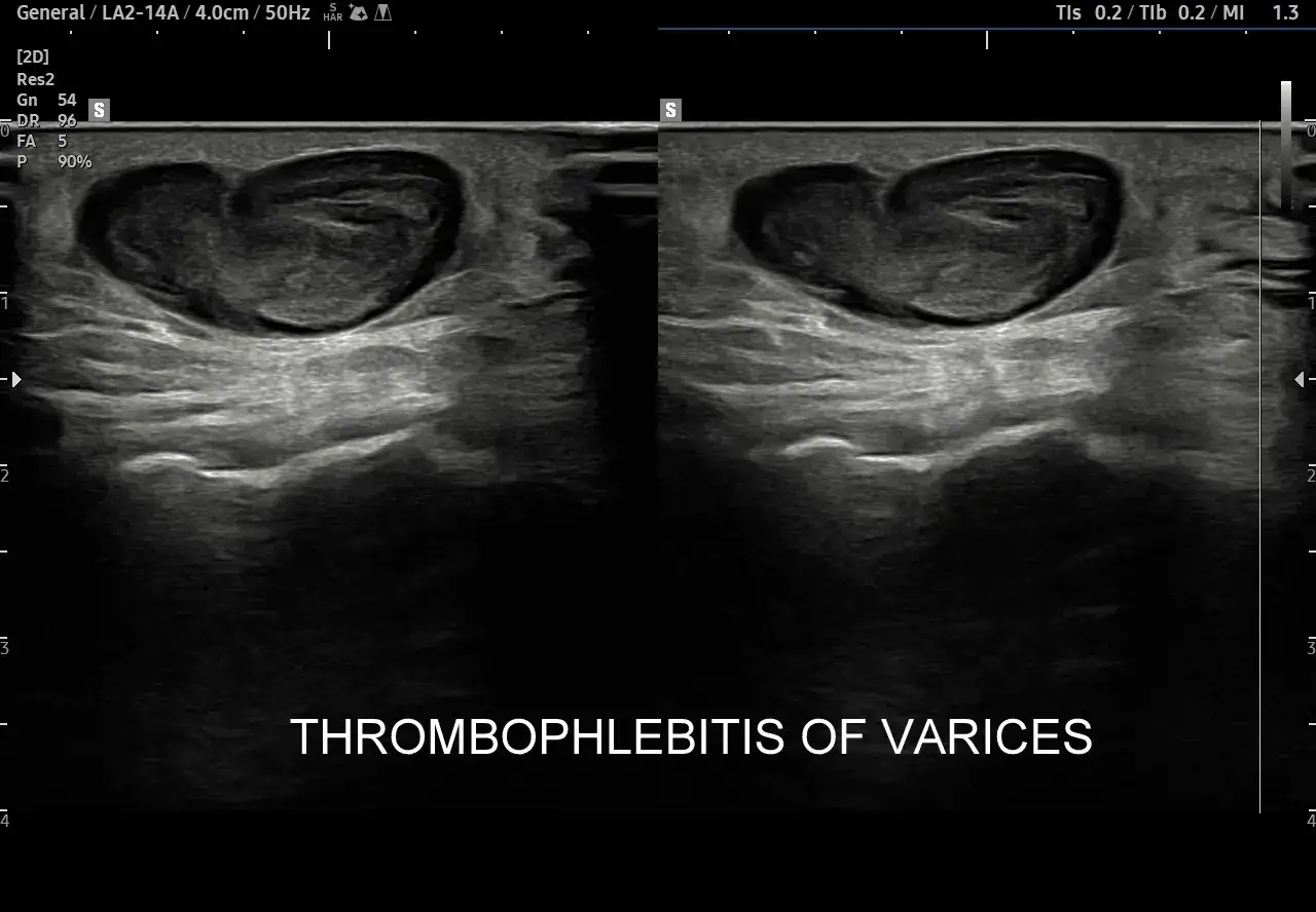 diagnostyka zakrzepicy USG Doppler