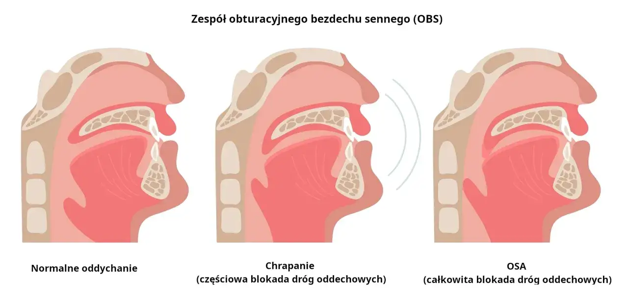 Czym jest obturacyjny bezdech senny? Mechanizm choroby