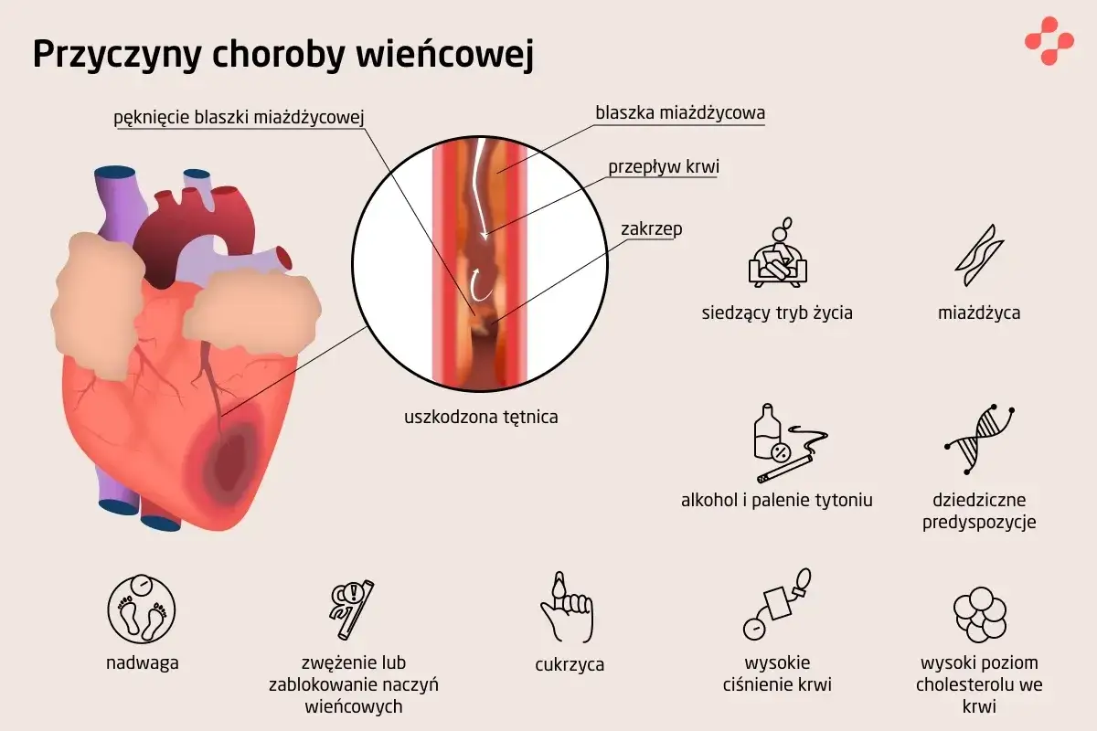 serce choroba wieńcowa schemat tętnic